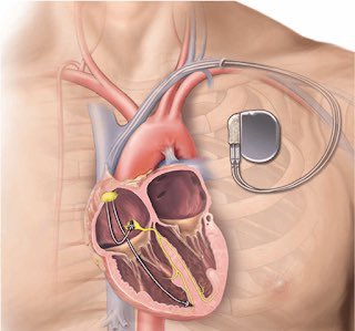 Réussite de la première implantation de pacemaker à N'Djaména grâce à la coopération tchado-hongroise