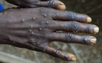 L’OMS s’inquiète d’une hausse sans précédent des cas de mpox en Afrique